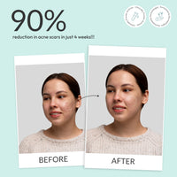 LAVISTER Niacinamide Night Gel for Acne Prone Skin With Peptides, Green Tea, Caffeine,Niacinamides, Tea Tree Oil | Fades Dark Spots, Acne Scars| Improves Skin Hydration| Suitable for All Skin Types | 50g