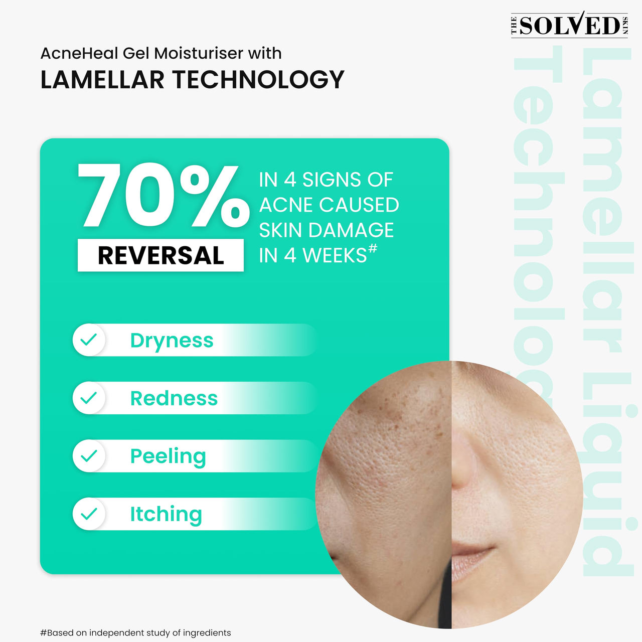 THE SOLVED SKIN India’s 1st Derma Tested Barrier Repair Gel Moisturiser With Lamellar Liquid Technology Reverses 4 Signs of Skin Damage by 70% Within 4 Weeks. 48 Hours Hydration. 50ml