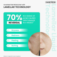 THE SOLVED SKIN India’s 1st Derma Tested Barrier Repair Gel Moisturiser With Lamellar Liquid Technology Reverses 4 Signs of Skin Damage by 70% Within 4 Weeks. 48 Hours Hydration. 50ml