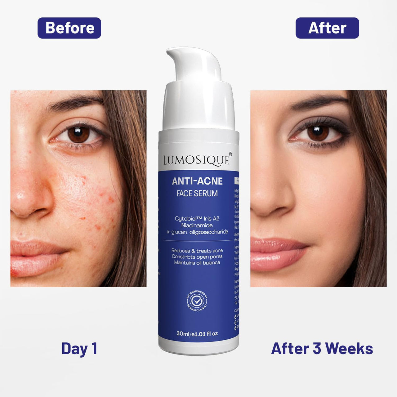 LUMOSIQUE® Anti Acne 2% Salicylic Acid Face Serum for Control Acne,Reduces Blackheads,Constrict Open Pores, Maintain Oil Balance & Hydrate Skin | For All Skin Types|For Men & Women | 30ml