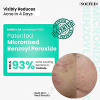 THE SOLVED SKIN India's 1st Dermatologically Tested Acnewash With Patented Micronized Benzoyl Peroxide. Kills 99% Acne Causing Bacteria, & Calms Inflamed Pimples in 4 Days. Normal to Oily Skin. 100ml (1, 100ml (Pack of 1))
