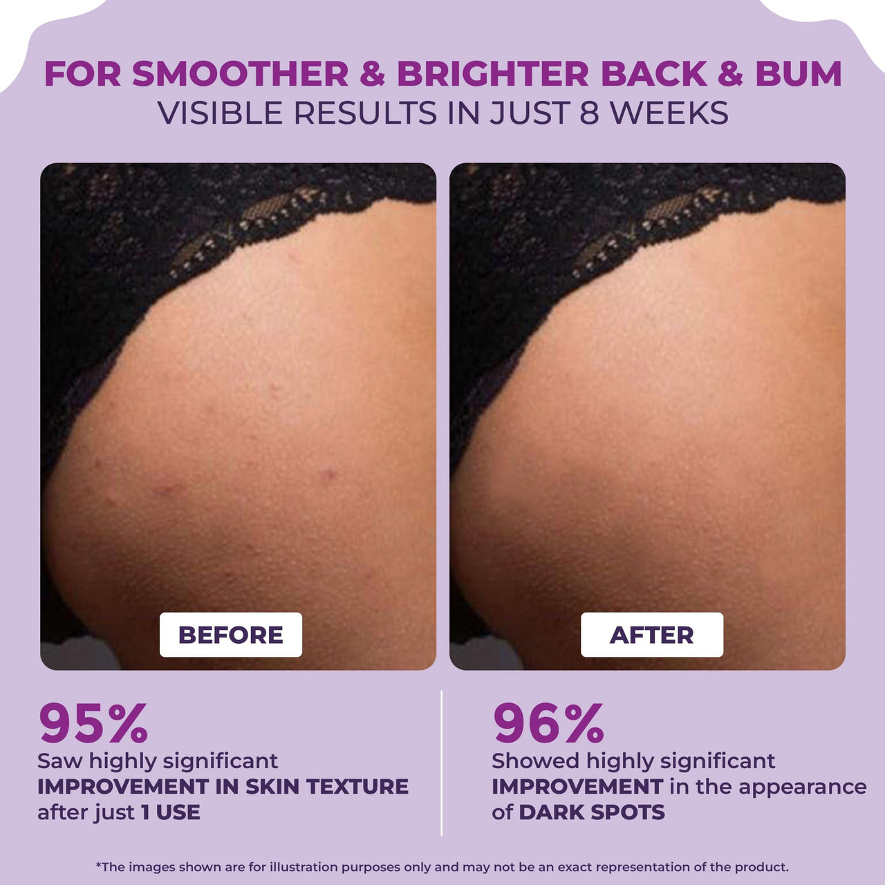Sanfe Back & Bum Cream for Dark Spots and Body Acne | Glycolic Acid, Lactic Acid & Urea | 11% AHA & Maximum Exfoliation | Remove Dead Skin for Women | 100gm
