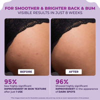Sanfe Back & Bum Cream for Dark Spots and Body Acne | Glycolic Acid, Lactic Acid & Urea | 11% AHA & Maximum Exfoliation | Remove Dead Skin for Women | 100gm