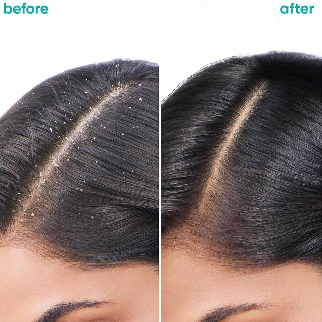 Biolage Professional Scalppure Anti-Dandruff Shampoo and Conditioner Combo, Removes Visible Flakes from 1st Use, Enriched with Bergamot, 2 Step Haircare Combo, Cruelty-Free, 200ml + 98g