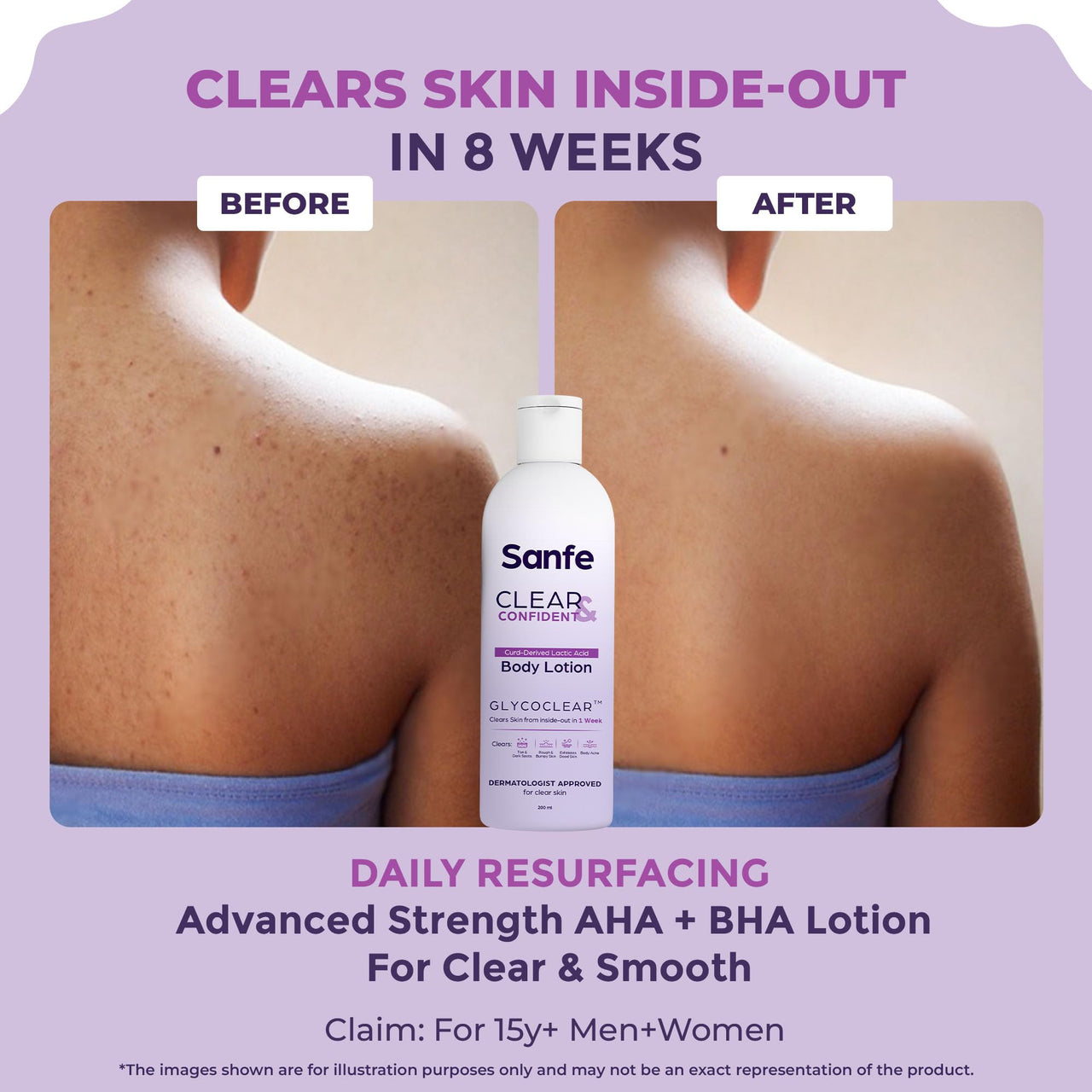 Sanfe Clear & Confident Glycolic Acid Body Lotion | Daily AHA Exfoliation for Rough & Bumpy Skin, Tan, Acne & Strawberry Skin | Niacinnamide, Lactic Acid SALICYLIC ACID 1% W/w | Smooth Skin from 1st Use | 200ml
