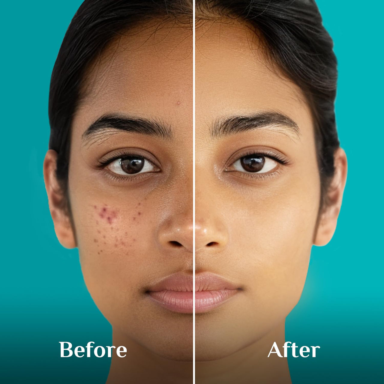 Pilgrim 10% Niacinamide Serum For Acne Marks | Niacinamide Serum For Oily Skin | Fades Blemishes & Dark Spots | Oil Control | Brightens & Evens Skin Tone | Korean Skincare | All Skin Types | Women & Men | 30ml |
