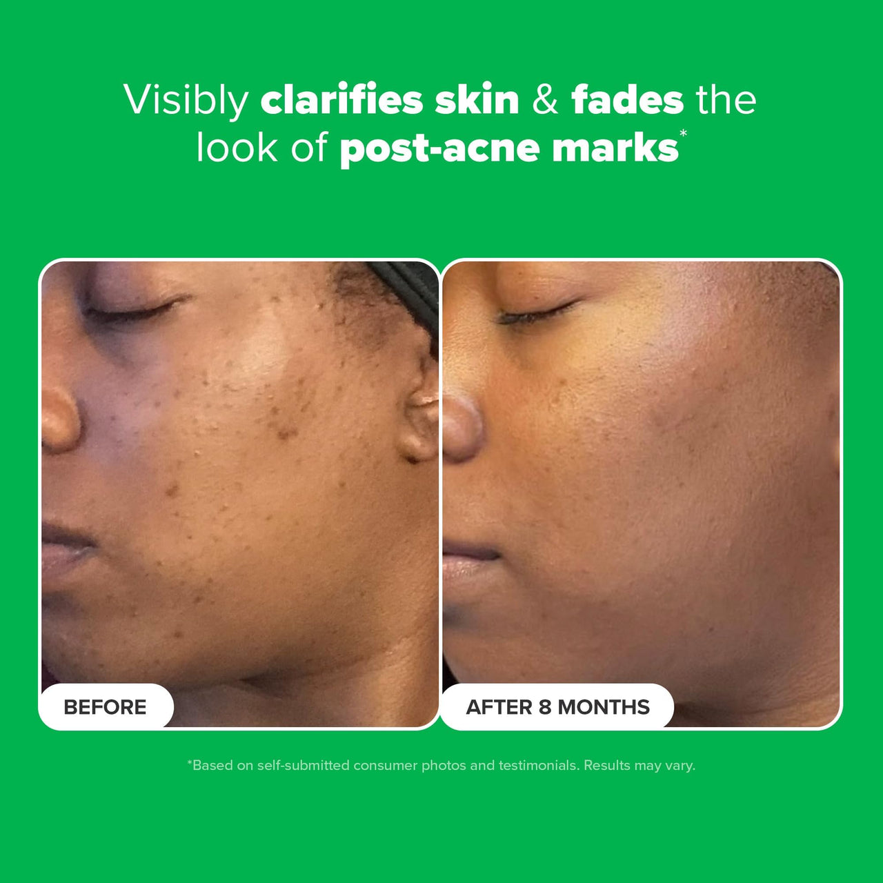 Paula's Choice BOOST 10% Azelaic Acid Booster Cream Gel Face Serum with Salicylic Acid, Oil-Free Skin Brightening Serum for Face, Fragrance-Free - 5 ml