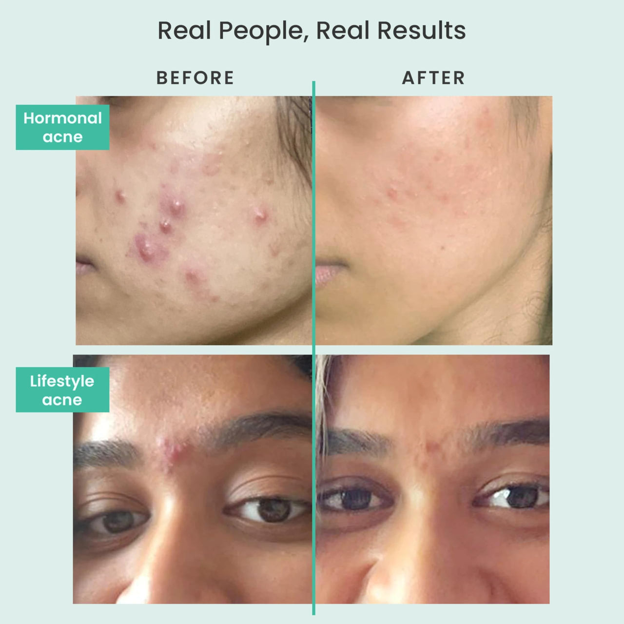THE SOLVED SKIN India's 1st Dermatologically Tested Acnewash With Patented Micronized Benzoyl Peroxide. Kills 99% Acne Causing Bacteria, & Calms Inflamed Pimples in 4 Days. Normal to Oily Skin. 100ml (1, 100ml (Pack of 1))