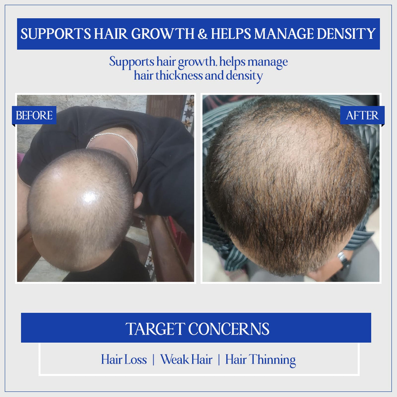 TYC - TRUST YOUR CHOICE Herbal Hair Growth Serum with 3% Redensyl, 1% Procapil & 1% Capilia Longa | Manages Hair Fall, Thinning & Loss | Encourages Hair Growth | pH 5.5, 50 ml