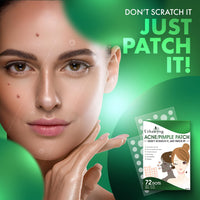 Urban Yog Acne Pimple Patch - (72 Dots) - Men and Women - (Pack of 3) (72 Dots * 3 Pack)