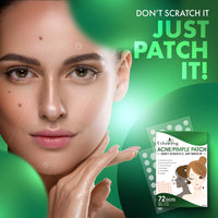 Urban Yog Acne Pimple Patch for Face (72 dots) | Waterproof Patches for Active Acne | Absorbs Pimple Overnight and Reduces Excess Oil | Facial Patches with 100% Hydrocolloid