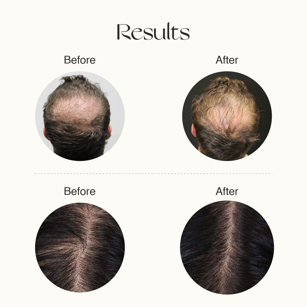 Nourish Mantra Advanced Hair Growth Serum/For Women & Men/Made With Redensyl, Anagain, Procapil & Rice Water/for Hair Fall/Hair Thinning & for All Hair Types (50 ml)