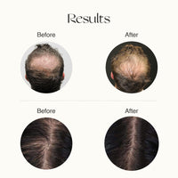 Nourish Mantra Advanced Hair Growth Serum/For Women & Men/Made With Redensyl, Anagain, Procapil & Rice Water/for Hair Fall/Hair Thinning & for All Hair Types (50 ml)
