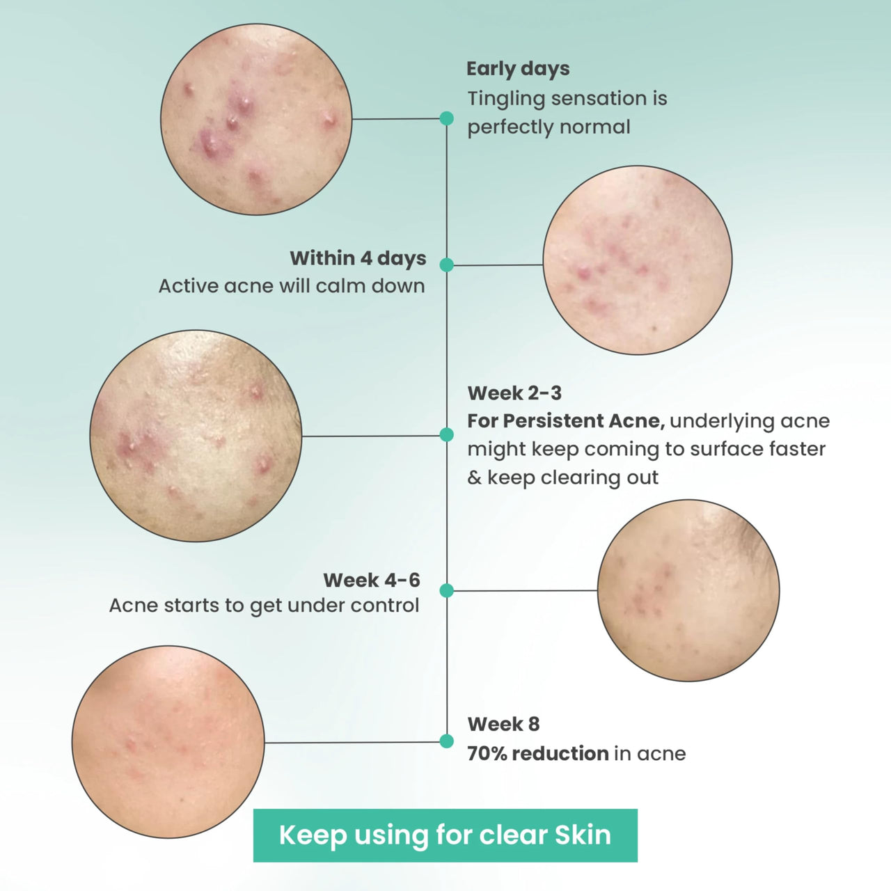 THE SOLVED SKIN India's 1st Dermatologically Tested Acnewash With Patented Micronized Benzoyl Peroxide. Kills 99% Acne Causing Bacteria, & Calms Inflamed Pimples in 4 Days. Normal to Oily Skin. 100ml (1, 100ml (Pack of 1))