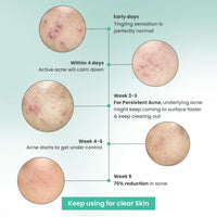 THE SOLVED SKIN India's 1st Dermatologically Tested Acnewash With Patented Micronized Benzoyl Peroxide. Kills 99% Acne Causing Bacteria, & Calms Inflamed Pimples in 4 Days. Normal to Oily Skin. 100ml (1, 100ml (Pack of 1))
