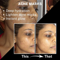 House of Beauty Acne Drying Serum - 30ml