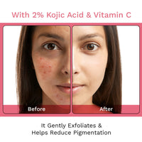 FURR 2% Kojic Acid Soap with Glutathione & Alpha-Arbutin | Cherry Blossom Extract | Reduces Pigmentation | Gently Exfoliates | Unisex | Suitable For All Skin Types | 75g (Pack of 2)