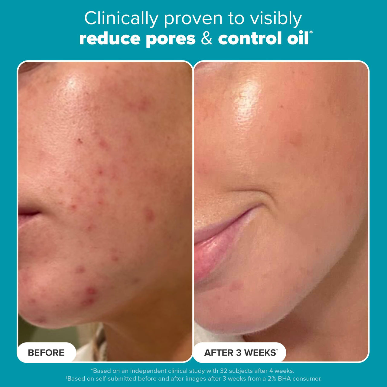 PAULA'S CHOICE SKIN PERFECTING 2% BHA Liquid Salicylic Acid Exfoliant-Facial Exfoliant for Blackheads, Enlarged Pores, Wrinkles, Fine Lines- 30 ml Bottle (Travel Size) (22016)