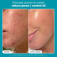 PAULA'S CHOICE SKIN PERFECTING 2% BHA Liquid Salicylic Acid Exfoliant-Facial Exfoliant for Blackheads, Enlarged Pores, Wrinkles, Fine Lines- 30 ml Bottle (Travel Size) (22016)