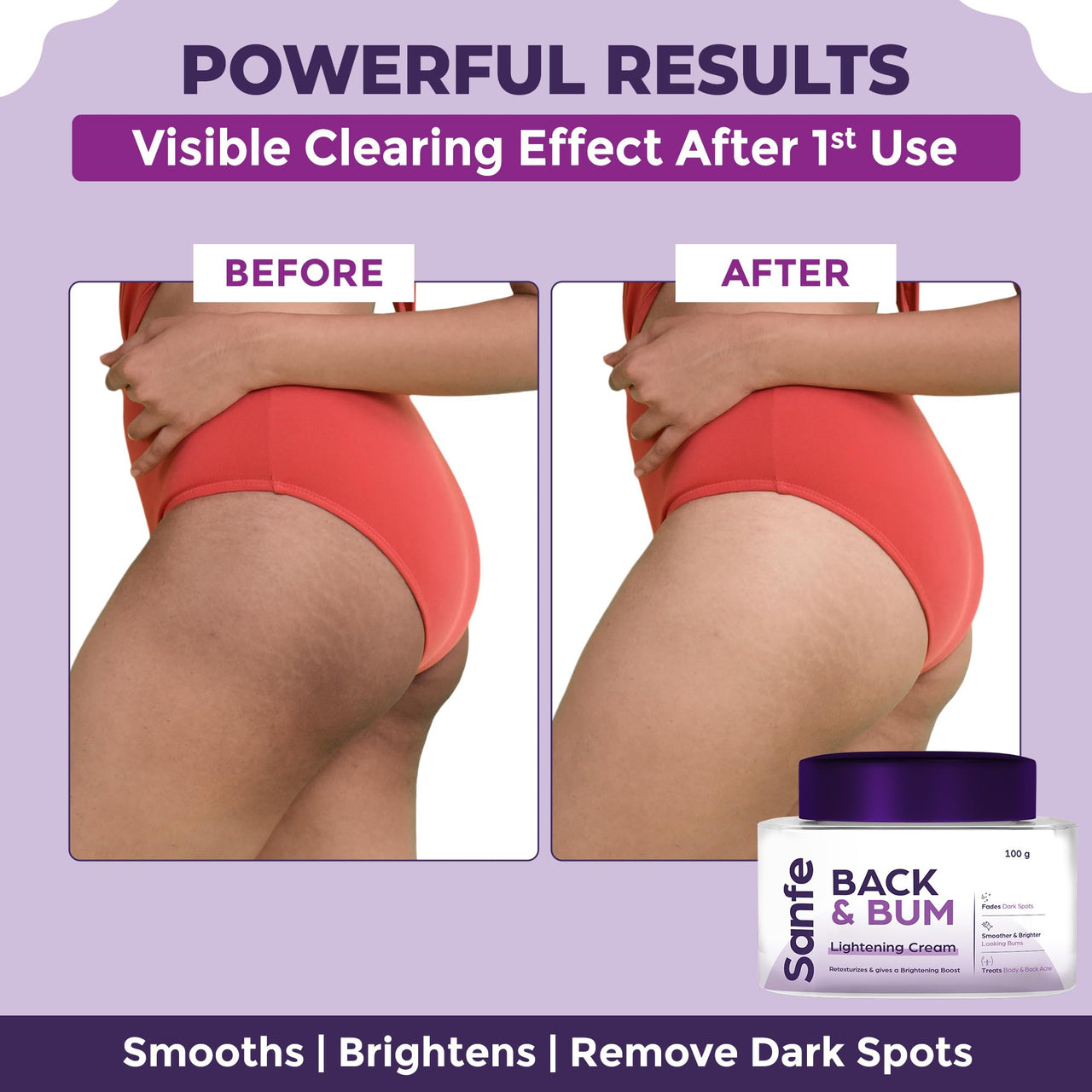 Sanfe Back & Bum Cream for Dark Spots and Body Acne | Glycolic Acid, Lactic Acid & Urea | 11% AHA & Maximum Exfoliation | Remove Dead Skin for Women | 100gm