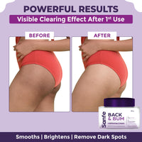 Sanfe Back & Bum Cream for Dark Spots and Body Acne | Glycolic Acid, Lactic Acid & Urea | 11% AHA & Maximum Exfoliation | Remove Dead Skin for Women | 100gm