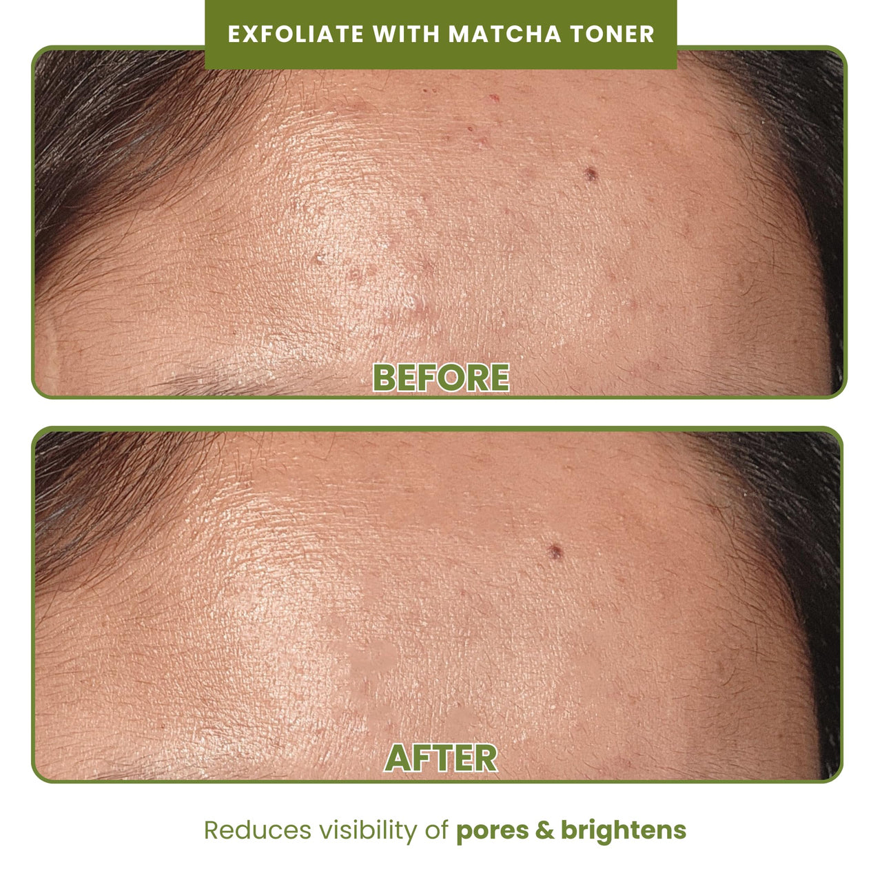 THE SKIN DIET COMPANY Exfoliate + Repair Saver Duo | Matcha Toner & Avocado Serum | Refreshing Exfoliation | Unclogs Pores, Improves Texture, Fades Pigmentation | All Skin Types (100ml + 15ml)