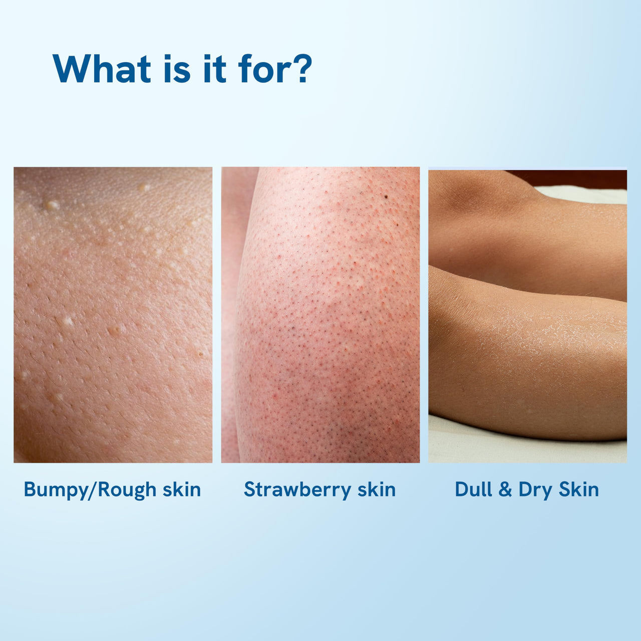 Be Bodywise 4% AHA BHA Shea Body Butter | 200g | With 48 hours of Intense Moisturization | For smooth and radiant skin