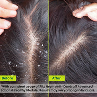PLIX - THE PLANT FIX | Neem Anti-Dandruff Advanced Lotion | Reduce Dandruff, Itching & Irritation | With Dandelix Pro & Ichthyol PALE | Paraben & Sulphate Free | Unisex (60ml)